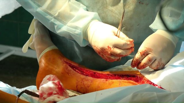 surgery leg vascular, close-up
