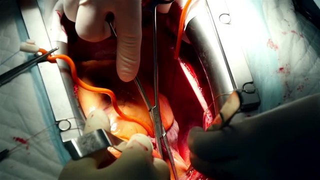 surgical operation on the human heart
