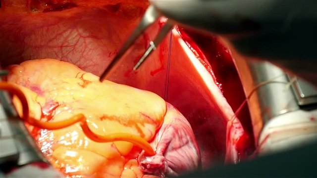 surgical operation on heart of a man, close-up, slow motion