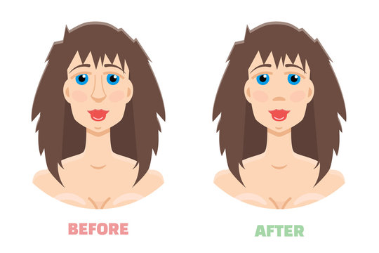 Plastic surgery, rhinoplasty before and after