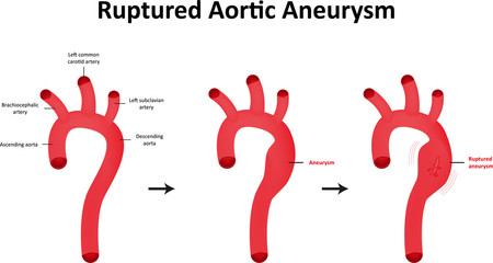 Ruptured Aortic Aneurysm Diagram - obrazy, fototapety, plakaty