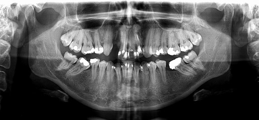 X ray of human mouth