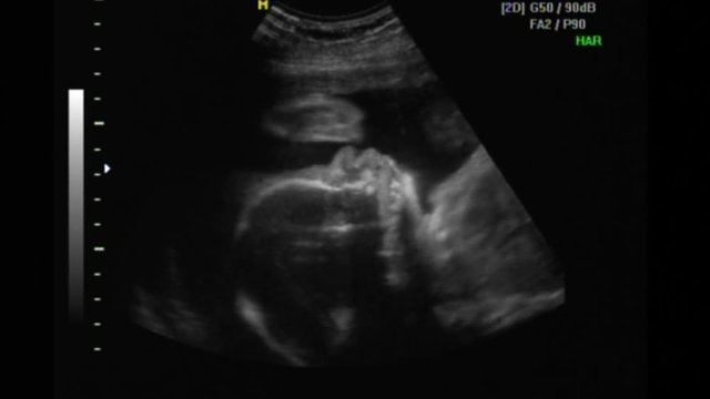 2D and 3D ultrasound of a beautiful baby at 23 weeks gestation