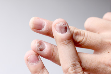 Fungus Infection on Nails Hand, Finger with onychomycosis. - soft focus