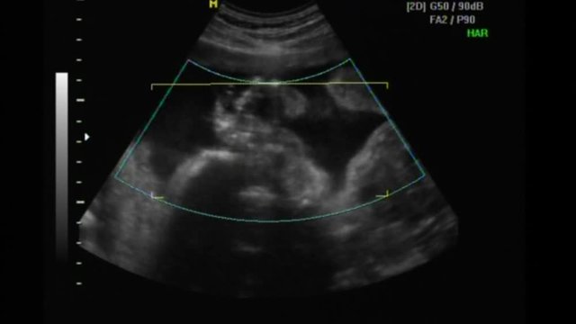 2D and 3D ultrasound of a beautiful baby at 23 weeks gestation