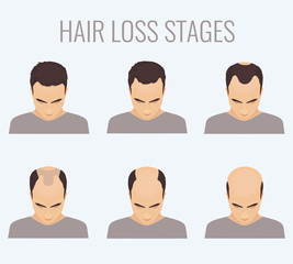 Male hair loss stages set. Top view portrait of a man losing hair. Male pattern baldness. Transplantation of hair. Signs of balding. Frontal hair loss. Vector illustration.
