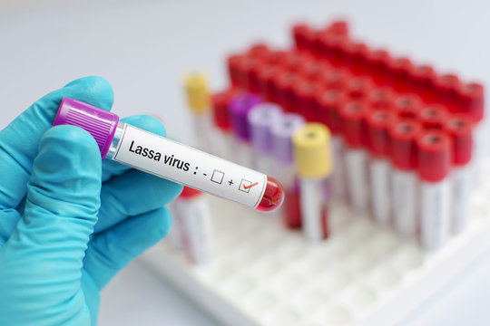 Blood sample positive with Lassa virus test
