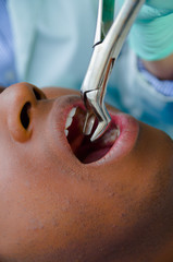 Closeup open mouth with dental tools inside, hispanic male patient getting tooth pulled out
