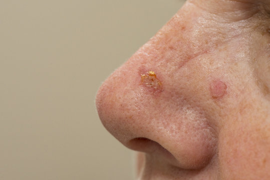 Close up of a nose that has been treated with cryosurgery for sun spots
