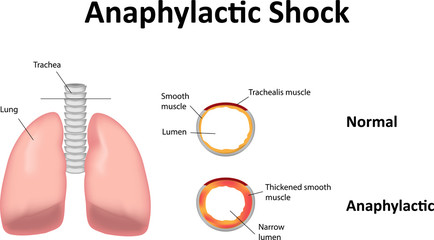 Anaphylactic Shock