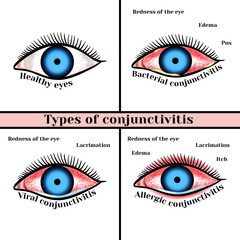 Conjunctivitis types. Inflammatory diseases of eyes.