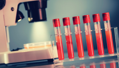 Blood test in medical laboratory, check sugar content  diabetes