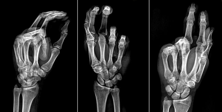Radiografia Frattura sottocapitata V metacarpo