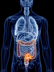 3d rendered, medically accurate illustration of bowel cancer