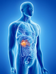 Obraz na płótnie Canvas 3d rendered, medically accurate illustration of kidney cancer