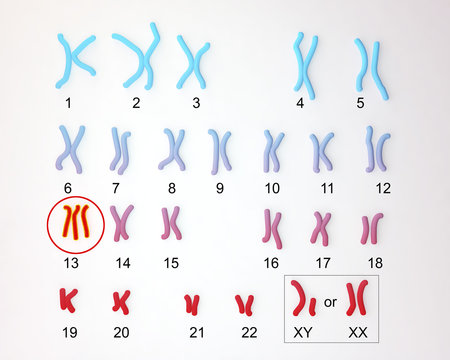 Patau-syndrome karyotype, male or female, labeled. Trisomy 13. 3D illustration