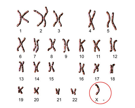 Turner’s-syndrome karyotype, labeled. X0 karyotype. 3D illustration