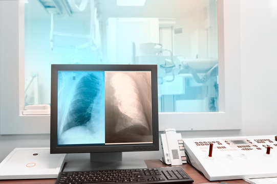 X-ray picture of lungs on a computer monitor