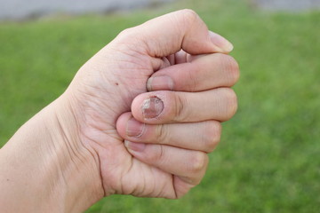 Finger with onychomycosis. A toenail fungus.. - soft focus