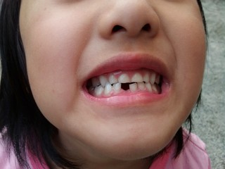 Fototapeta premium 歯が抜けた少女