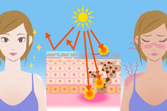 UV care before after image, young girl puts on the sunscreen or not, mechanism of the sunburn, vector illustration