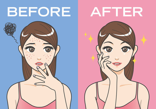 Acne Treatment Before After Cartoon Illustration