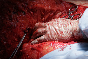 Surgeon's hand in glove close-up lying on the flesh covered in blood