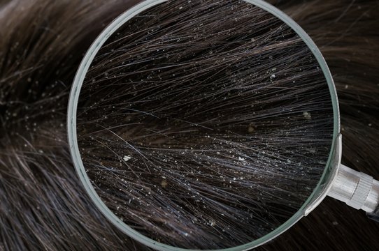Examiming white dandruff flakes in hair with magnifying glass.