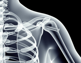 x-ray image of a  bone with a screw - obrazy, fototapety, plakaty