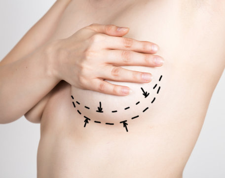 doctor makes dotted line on female body for cellulite correction. cosmetic surgery. lifting and breast augmentation