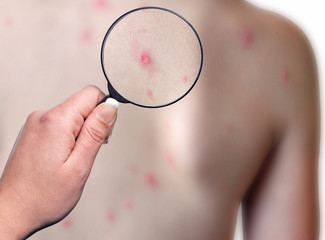 Patient with chickenpox disease, medical examination - obrazy, fototapety, plakaty