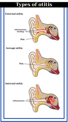 Types of otitis : external, average and internal otitis. Inflammatory diseases of the ear.      