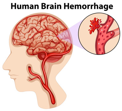 Diagram of human brain hemorrhage