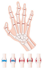 Rheumatoid arthritis diagram on white