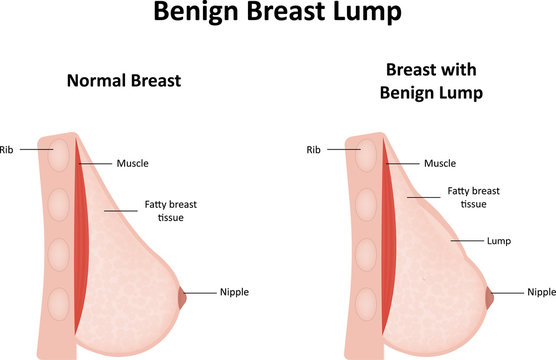Benign Breast Lump