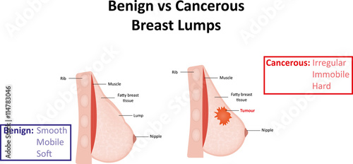"Benign Vs Cancerous Breast Lumps" Stock photo and royalty ...