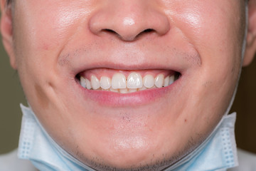 Detailed image of young man smiling with perfect white teeth
