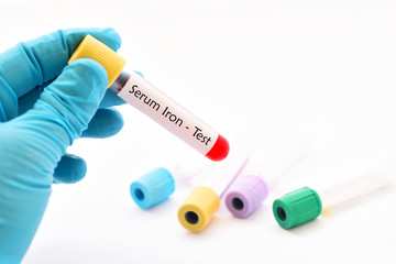 Blood sample for serum iron (SI) test