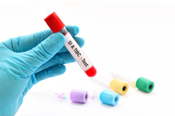 Blood sample for serum iron (SI) and total iron binding capacity (TIBC) test
