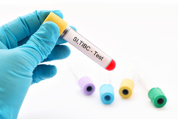 Blood sample for serum iron (SI) and total iron binding capacity (TIBC) test
