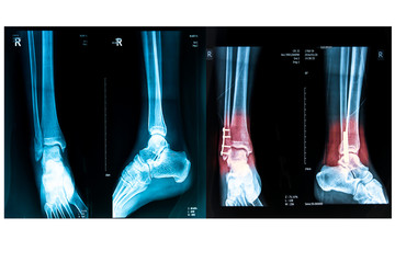 human foot right ankel xray picture with plate and screws