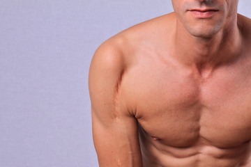 Man man with scar on his hand shoulder. Laser Scar Reduction concept