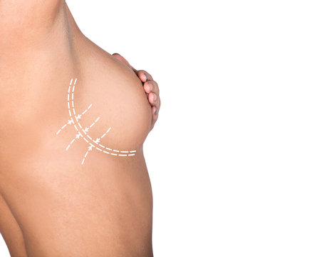 plastic or cosmetic surgery, cellulite correction, people and bodycare concept. female bust with lines. breast augmentation