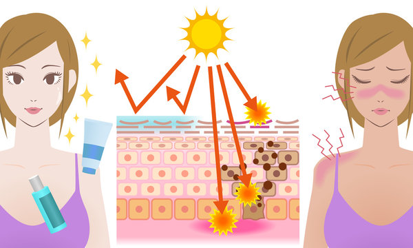 UV care before after image, young girl puts on the sunscreen or not, mechanism of the sunburn, vector illustration