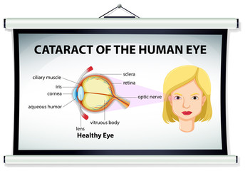 Diagram of cataract in human eye - obrazy, fototapety, plakaty