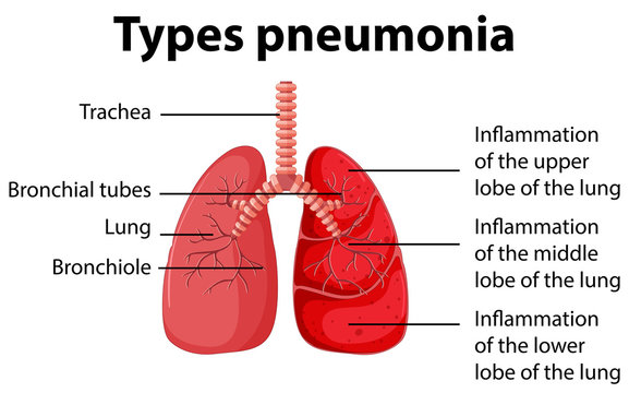 Diagram showing types pneumonia