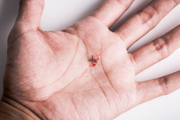 smashed mosquito full of blood on a palm.
