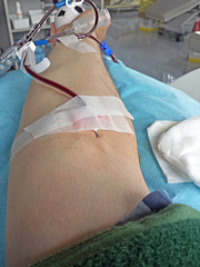 man during a blood transfusion