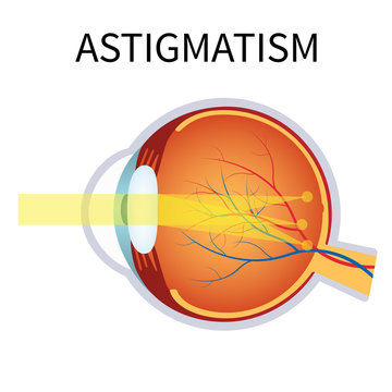 Astigmatism. Eyesight problem, blurred vision.