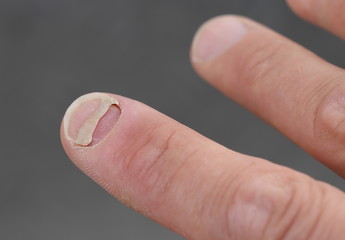 Ablösender Fingernagel